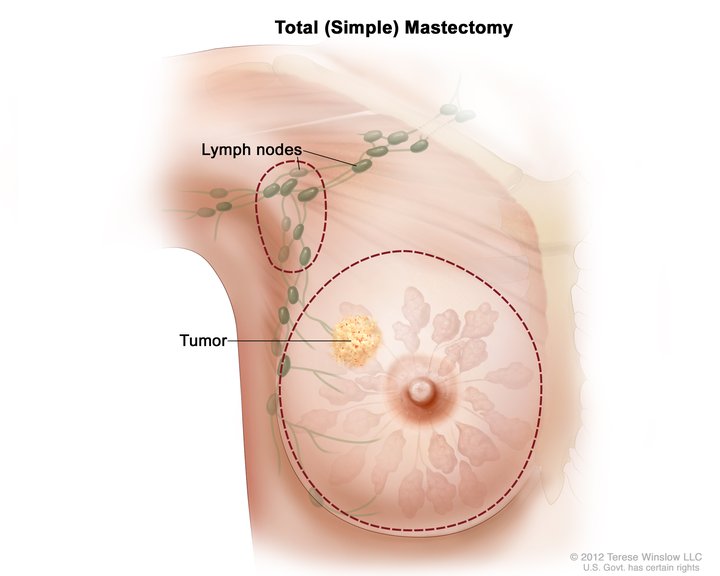 Breast Cancer Gene – Preventive Surgery?